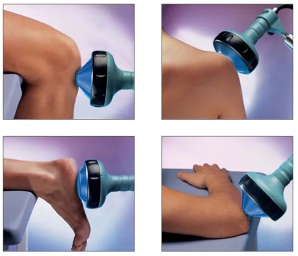 piezowave 2 acoustic wave therapy in naples